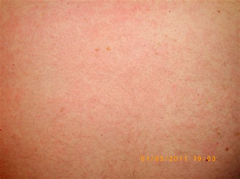 Red Rashes On Chest Pictures Photos