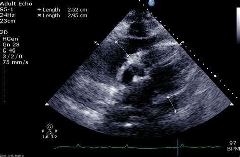 A Case Of Myopericarditis Caused By Neisseria Meningitidis W135