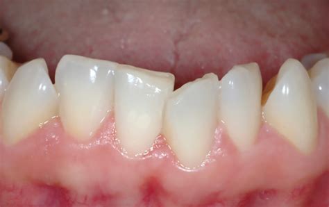 Apinhamento Dental Press O Portal De Conteúdo De Odontologia