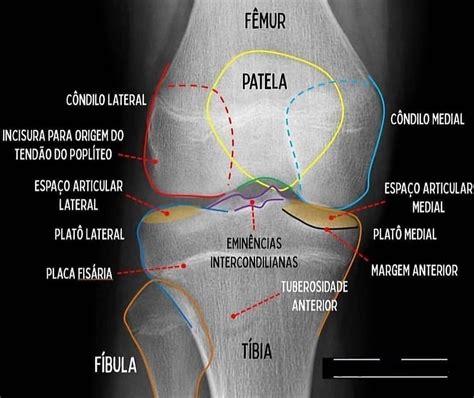 Radiologia On Instagram Anatomia Radiogr Fica Do Joelho Siga