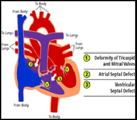 What Are Ventricular Septal Defects Hot Sex Picture