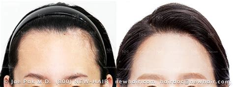Before And After Forehead Reduction For Women