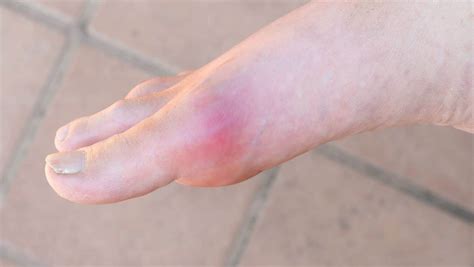 Turf Toe Anatomy Symptoms And Treatment Turf Toe Taping