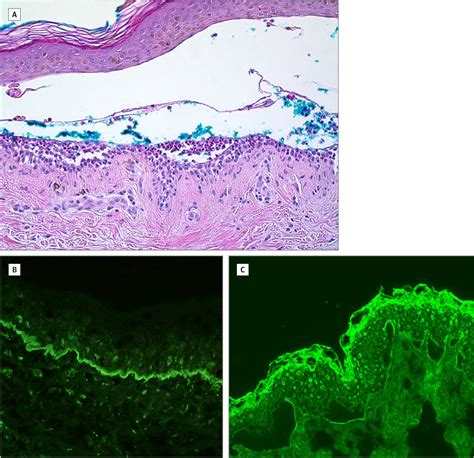 Detection Of Type Vii Collagen Autoantibodies Before The Onset Of Bullous Systemic Lupus