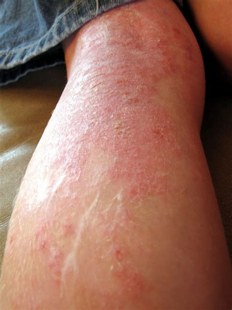 Eksim merupakan kondisi kulit yang disebabkan oleh peradangan pada kulit. Cara mengobati penyakit eksim kering dan basah | Info ...