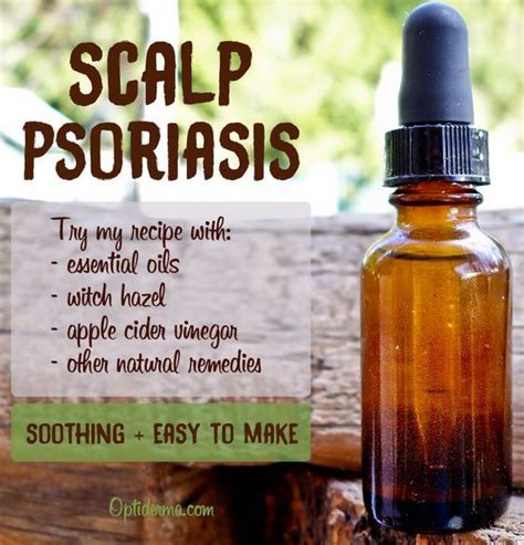 Psoriasis On Scalp Try This Soothing And Moisturizing Diy Recipe With