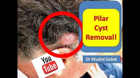Large Pilar Cyst Removal Lipomacyst Com Dr Khaled Sadek Youtube