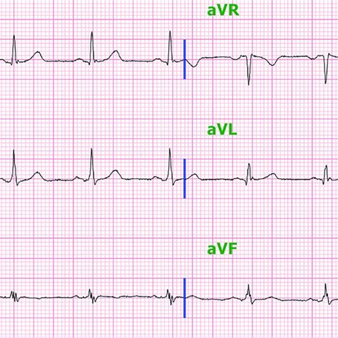 12 Lead Electrocardiogram Of The Patient Showing The Anteroseptal Q