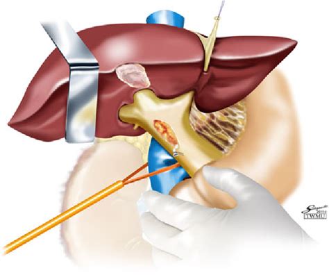Right Hepatectomy Using Glissonean Pedicle Transection Method With