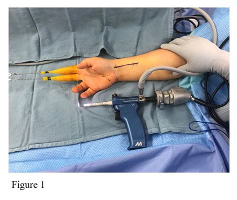 Aahs Concurrent Endoscopic Carpal Tunnel Release And Distal Radius Fracture Fixation Using The