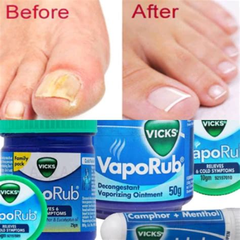 Does Vicks Vaporub Or Other Home Remedies Really Work On Toenail Fungus Toe Nail Discoloration