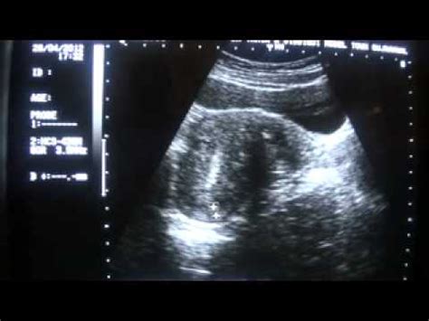 Retroverted Uterus Transabdominal Ultrasound