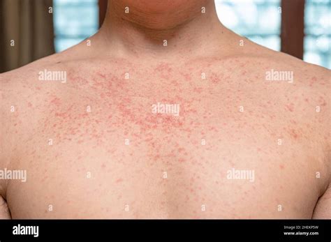 Dermatite Eruzione Cutanea Malattia Virale Con Immunodeficienza Sul