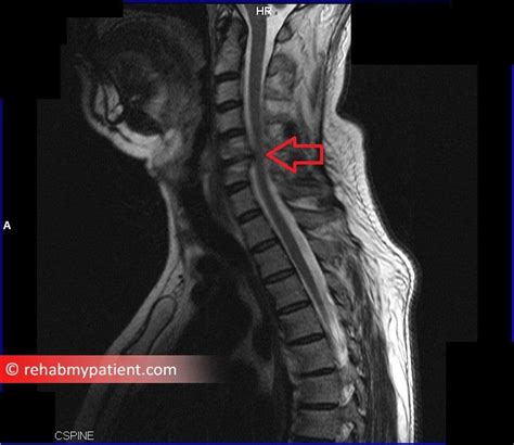Cervical Radiculopathy Pinched Nerve Rehab My Patient