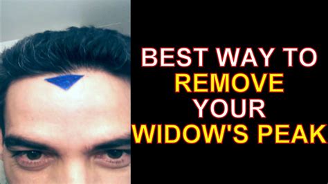 Best Widows Peak Removal Technique Forehead V Hairline Quick Fix