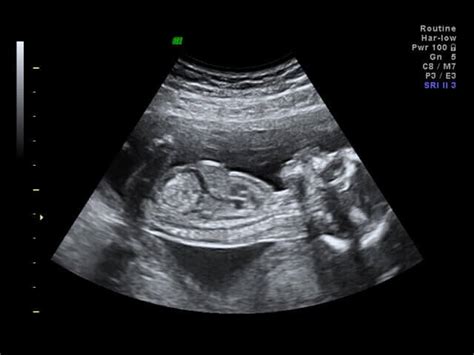 Private Early Pregnancy Scans Explained What Will I See Ultrasound