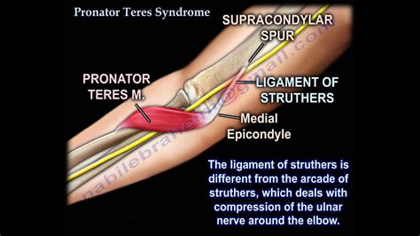 Pronator Teres Syndrome Everything You Need To Know Dr Nabil Ebraheim YouTube
