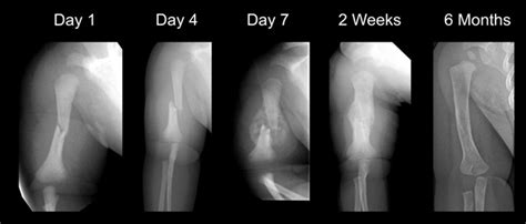 Throughout the stages of fracture healing, the bones must be held firmly in the correct position. Fracture Education : Fracture healing