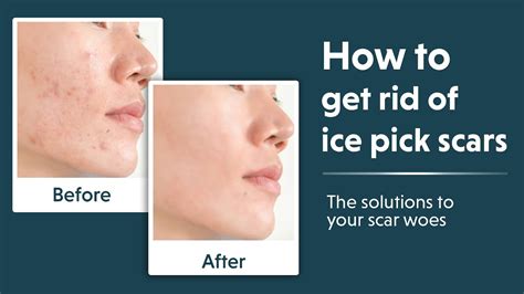 Ice Pick Scars Removal Treatment How To Remove Ice Pick Scars Youtube