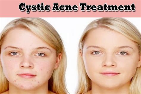 What Is Cystic Acne And How To Treat It At Home Naturally Hergamut