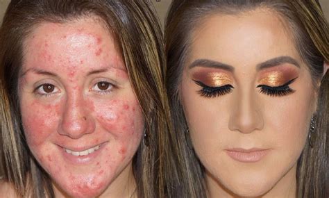 Cystic Acne Makeup Makeover Newbeauty