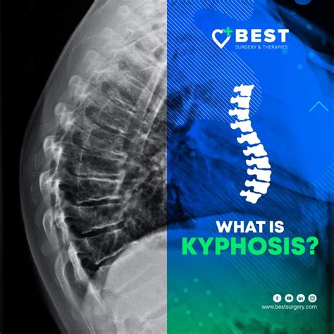 What Is Kyphosis Best Surgery Center