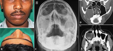 Unusually Large Radicular Cyst Presenting In The Maxillary Sinus Bmj