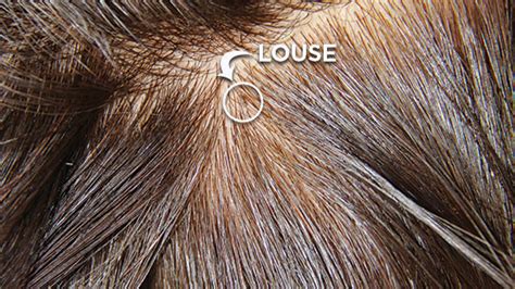 You have to get rid of all the nits. Head Lice Screening Options | Lice Clinics of America ...