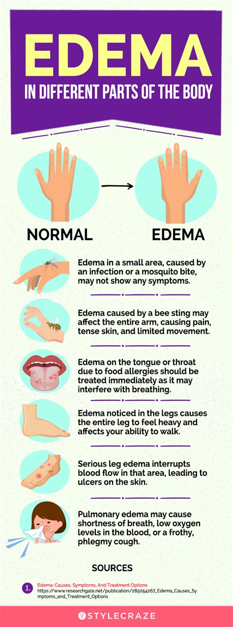 Pitting Edema What Is It Causes Grading Diagnosis 43 Off