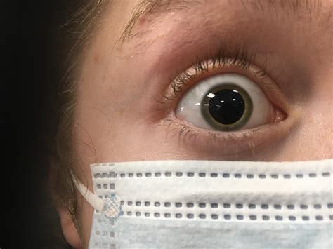 The Size Of My Pupil After Having Eye Drops Rmildlyinteresting