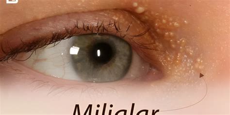 Milialar Small Bumps Under The Skin Explained