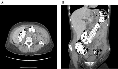 Resolution Of The Small Bowel Intussusception Multiple Small Bowel