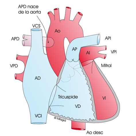Hemitronco Arterial Arteria Pulmonar Nace De La Aorta