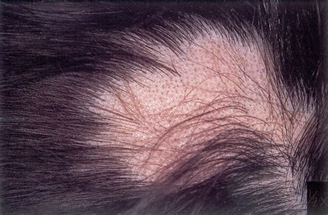 Alopecia Areata Types Symptoms And Treatments Haywards Heath