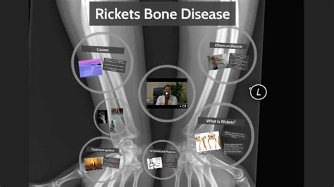 Rickets Bone Disease By Luis Lombardo