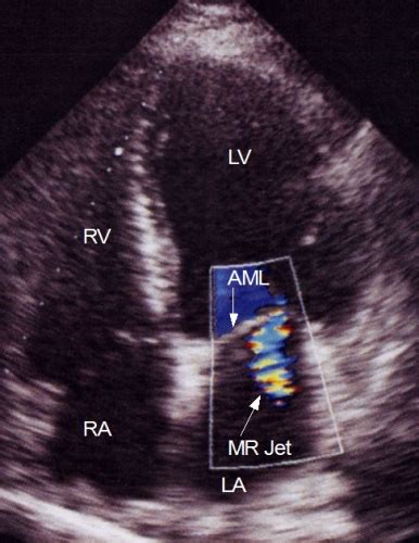 Mitral Regurgitation Jet By Color Doppler Echocardiography All About
