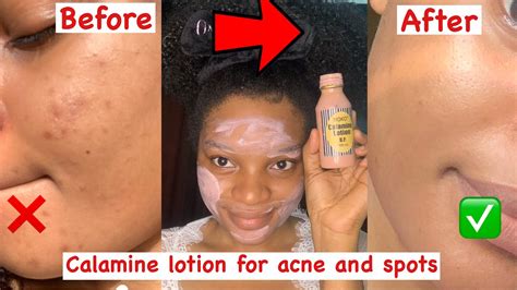 Are You Supposed To Wash Off Calamine Lotion Top 6 Best Answers