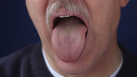 Less Tongue Fat From Weight Loss May Help Sleep Apnea
