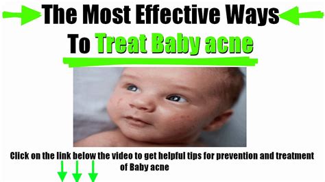How To Treat Baby Acne Youtube