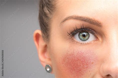 What Are Red Cheeks A Symptom Of