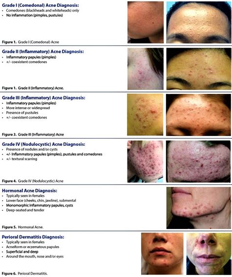 Acne And Pimples Caises Best Treatment To Get Rid Of Acne And Pimples