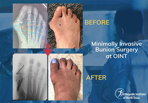 Minimally Invasive Bunion Surgery Plano Bunion Deformity Frisco