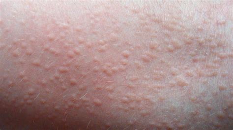 Baby Acne Cure And Treatment Baby Heat Rash Pictures