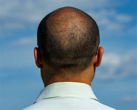 Dealing With A Balding Crown Why It Happens And How To Treat It Myhair
