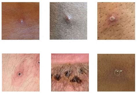 Monkeypox On Skin What To Know About Symptoms Rash Spread Amid Virus