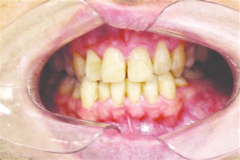 Mass Lesion Leading To Effacement Of The Mucobuccal Fold Extending