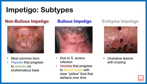 Introduction To Impetigo Infection Subtypes And Treatment New Wound