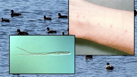 Swimmers Itch An Unfortunate But Treatable Affliction During Alaska