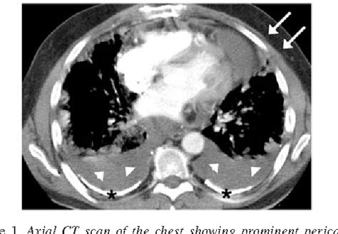 Figure 1 From Primary Pericardial Mesothelioma In An Asbestos Exposed