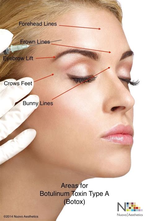 Wrinkle Reducing Injections Eyebrow Lift Botox Injections Botox